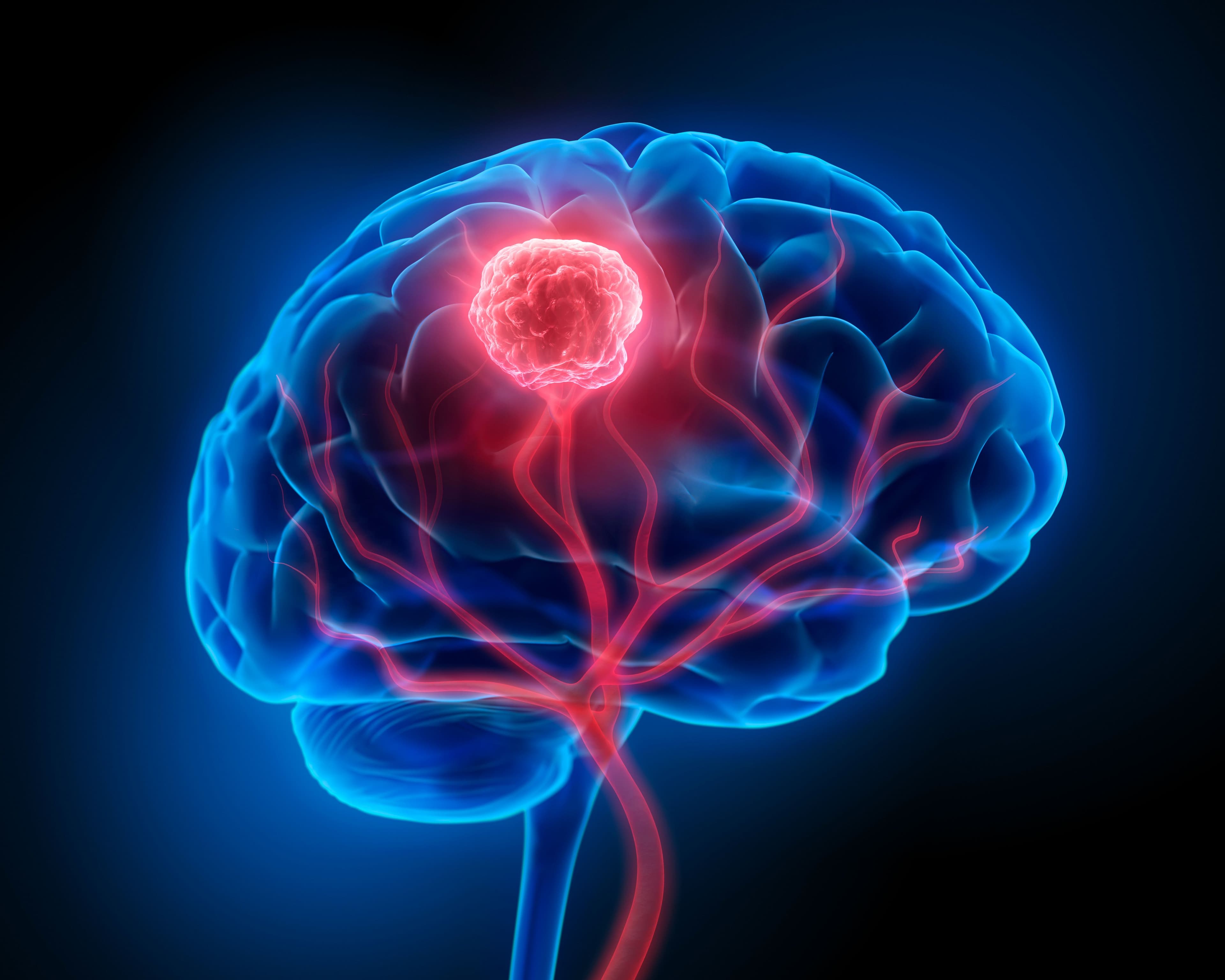 Tumori del cervello, lo specialista: «L’unico modo per vedere se qualcosa non va è la risonanza magnetica, ma farla a tutta la popolazione come screening sarebbe impensabile e controproducente»