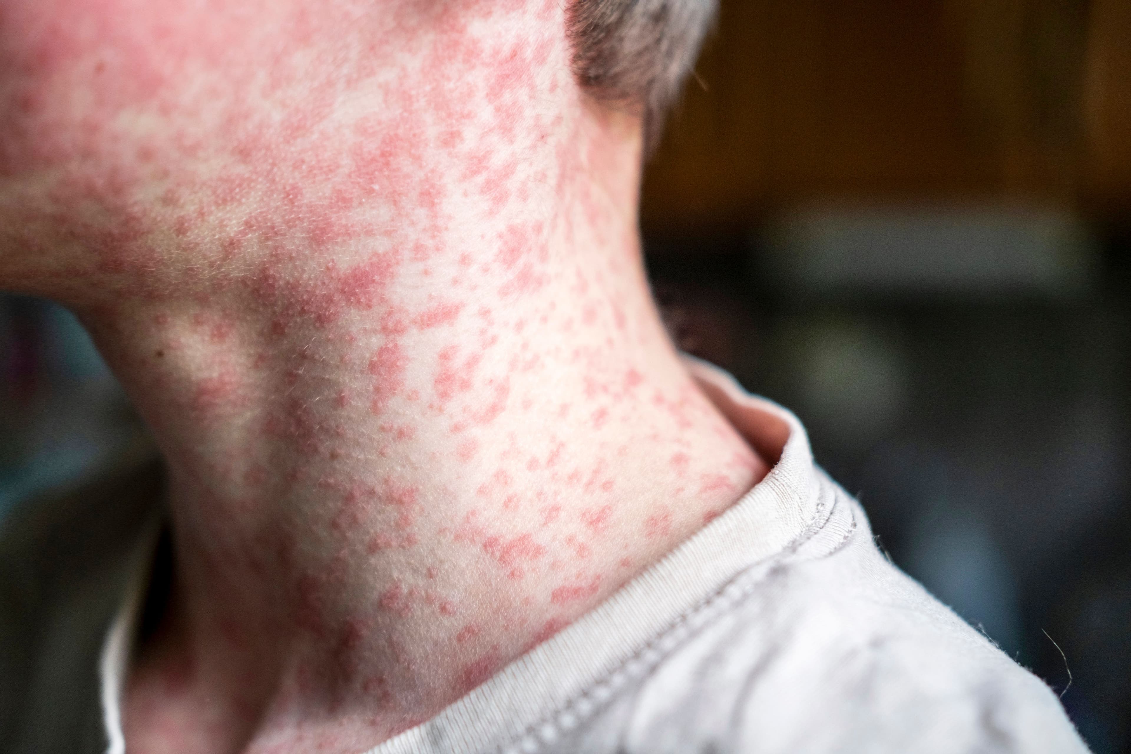 Morbillo, l’Italia è prima in Europa per numero di casi: pesa il calo delle vaccinazioni