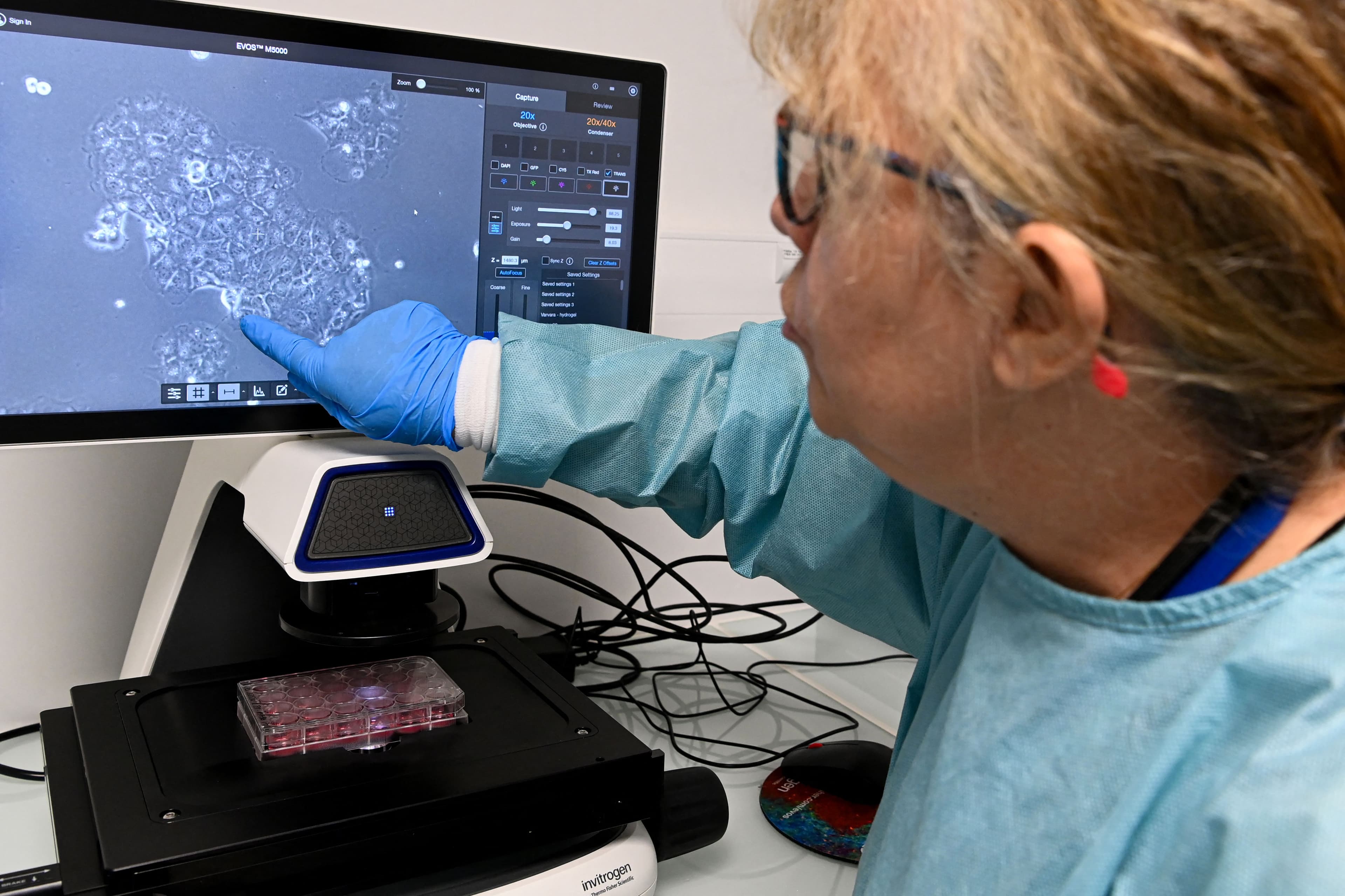 Tumore del pancreas, un nuovo esame del sangue individua le tracce della malattia con maggiore precisione. Che cosa sappiamo